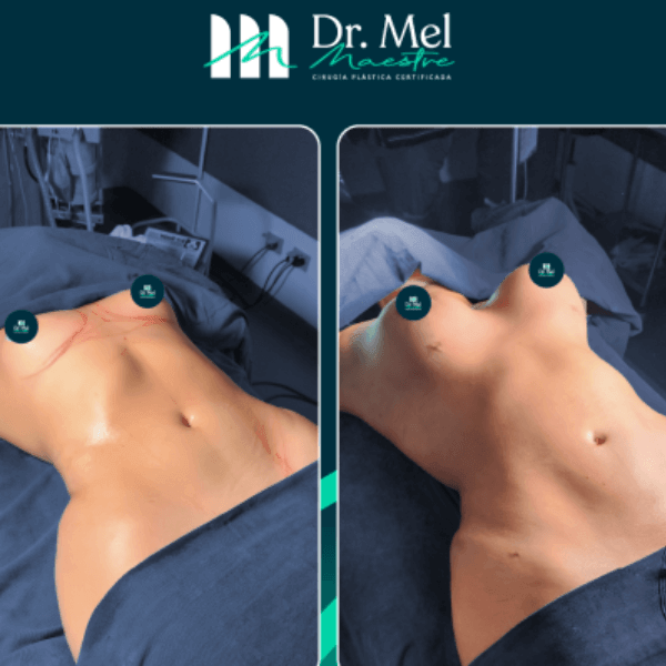 Mamoplastia de aumento